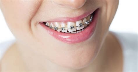 dental ortho metal dental orthodontic brackets|pictures of traditional steel braces.